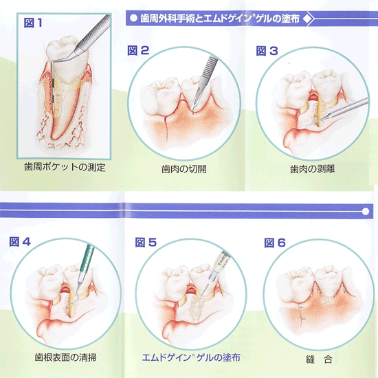 歯周外科手術とエムドゲインゲルの塗布