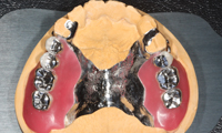 金属部分床義歯
