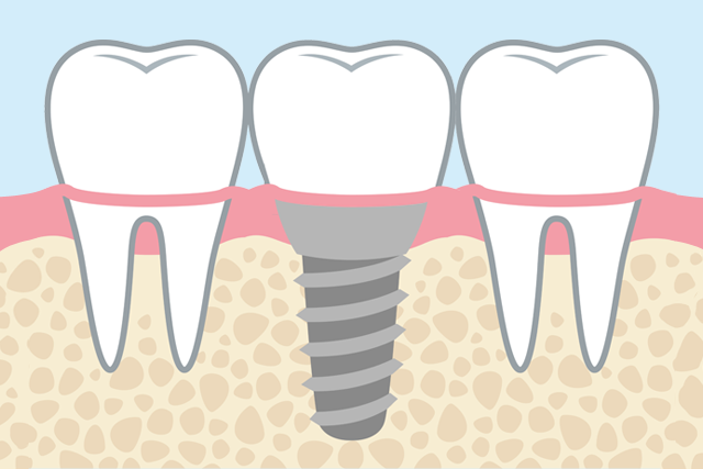 インプラント治療