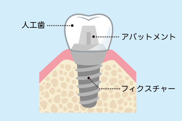 インプラント治療