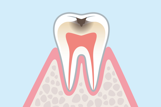 むし歯治療
