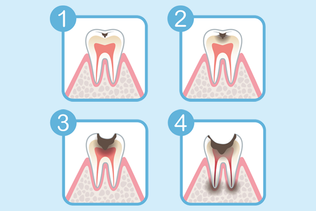 むし歯 重症度