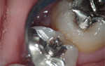 顕微鏡歯科治療 症例