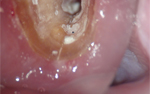 顕微鏡歯科治療 症例