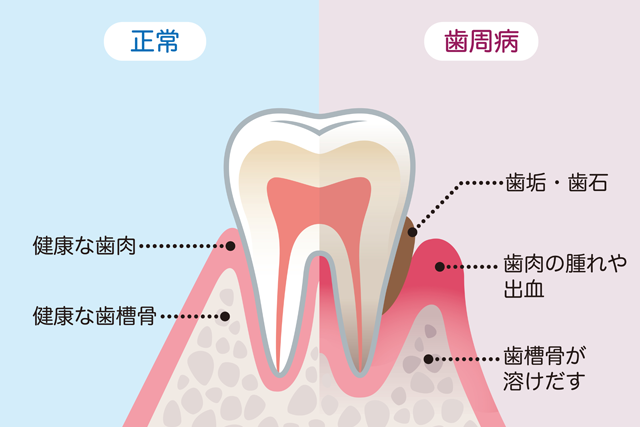 歯周病